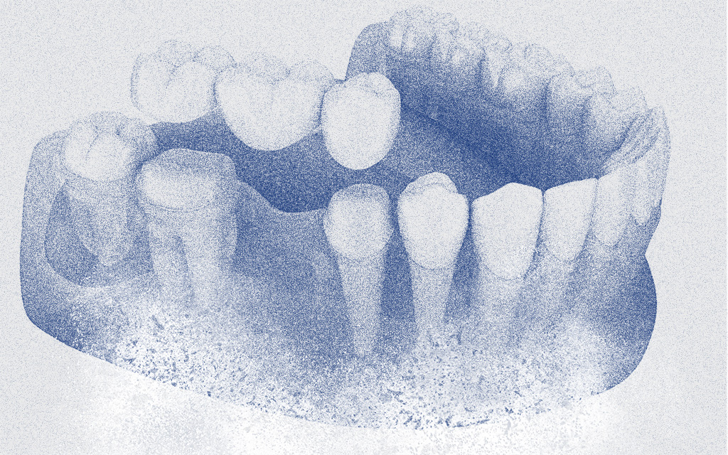 Affordable Dental Implants in Scarborough