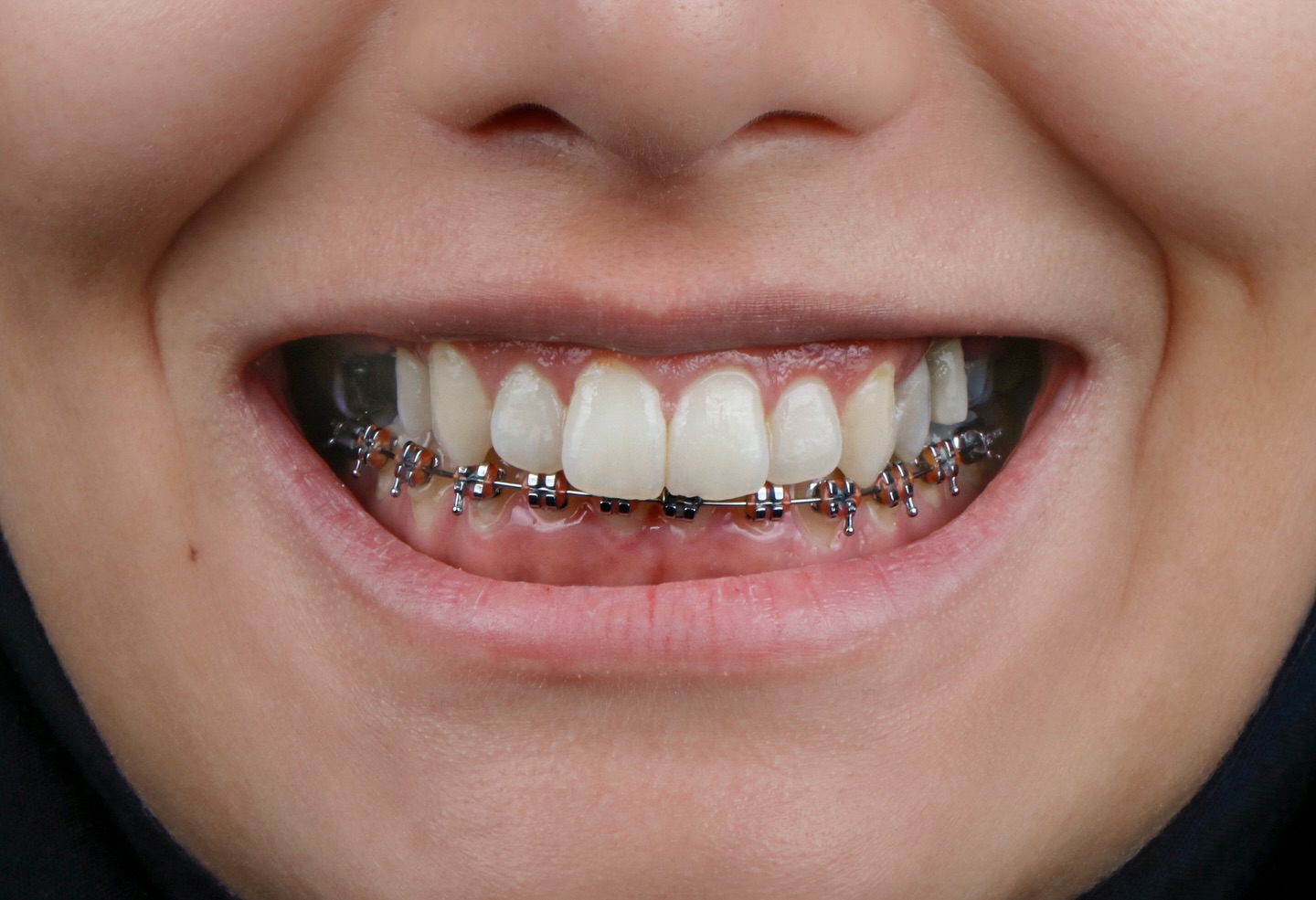 Orthodontic real photo before and after