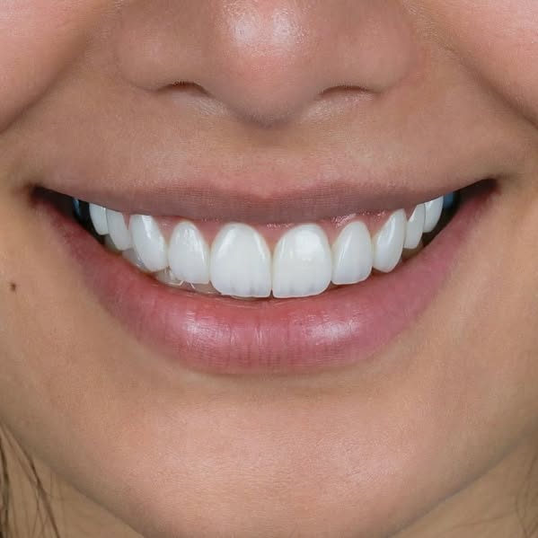 Orthodontic  real photo before and after