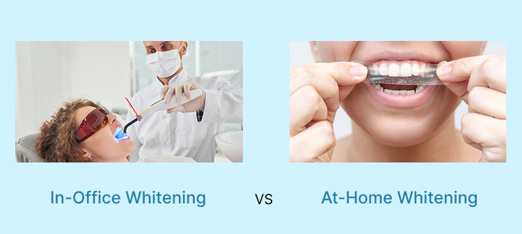 Differences Between In-Office and At-Home Whitening