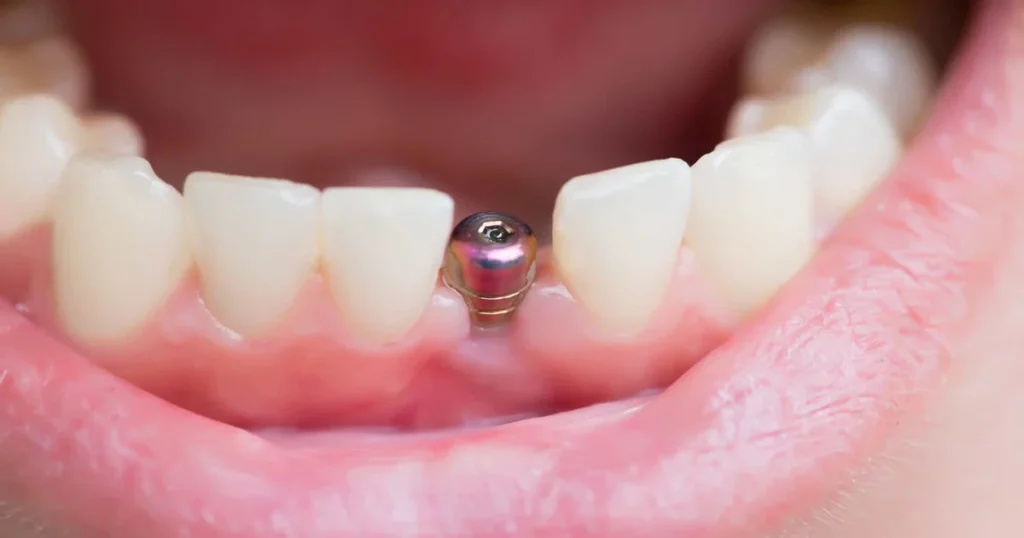 a picture representing dental implants