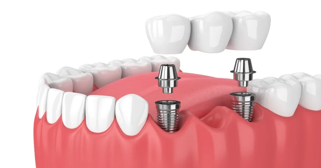 A picture of dental implants