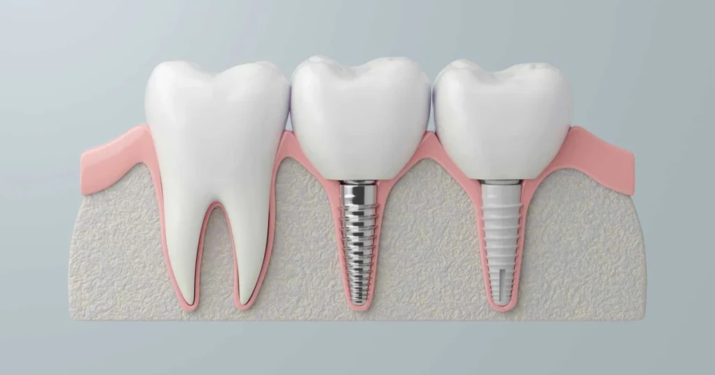 A picture of different types of implants