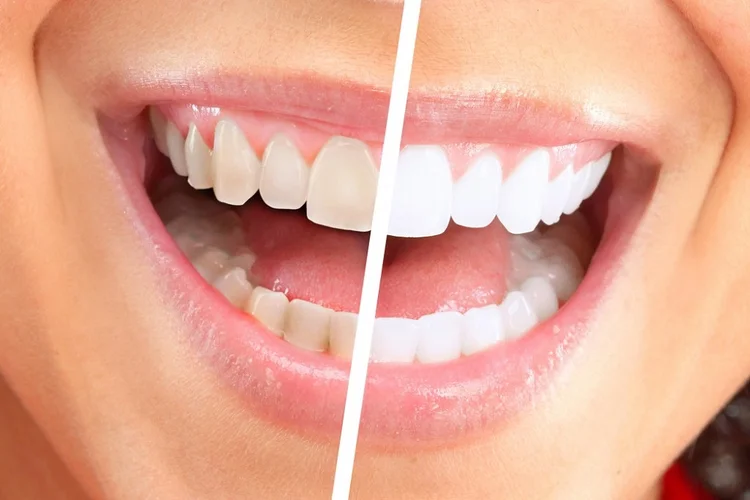A picture representing the comparison between cleaned teeth vs non-cleaned