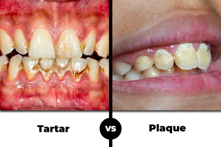 A picture comparing plaque to tartar