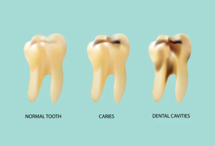 Things to do to prevent cavities