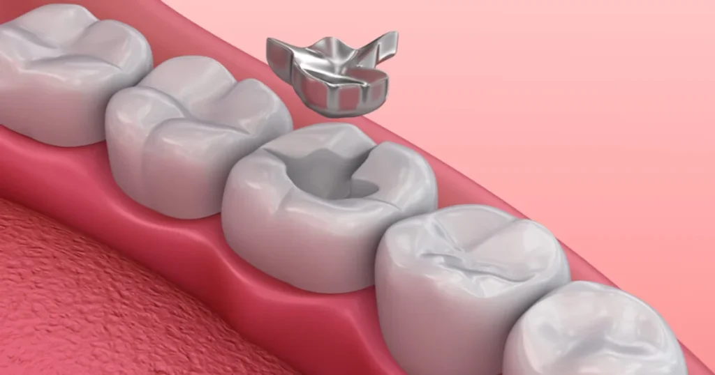 A picture representing dental fillings
