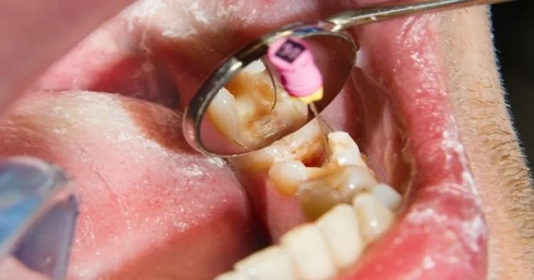 A picture of root canal treatment procedure