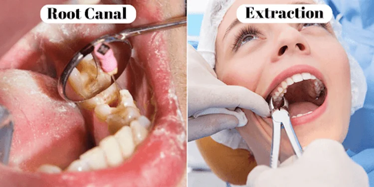 A picture demonstarting both tooth extraction and root canal