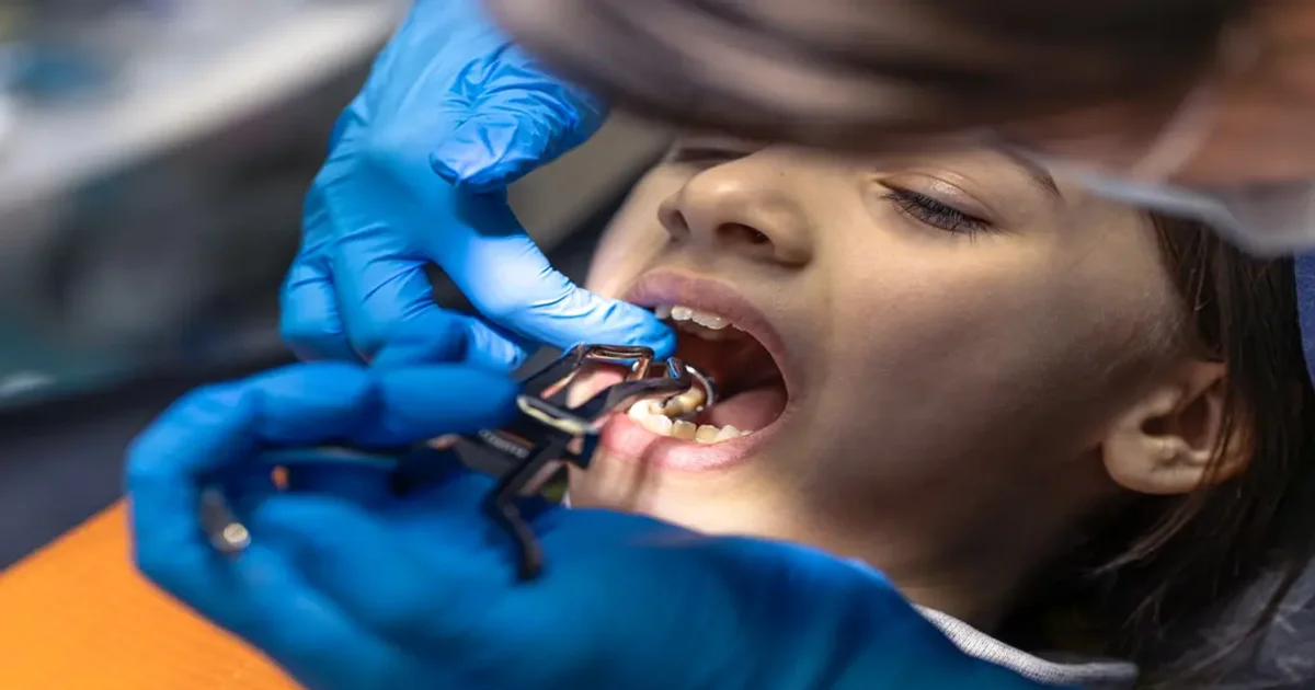 A picture of a tooth extraction procedure