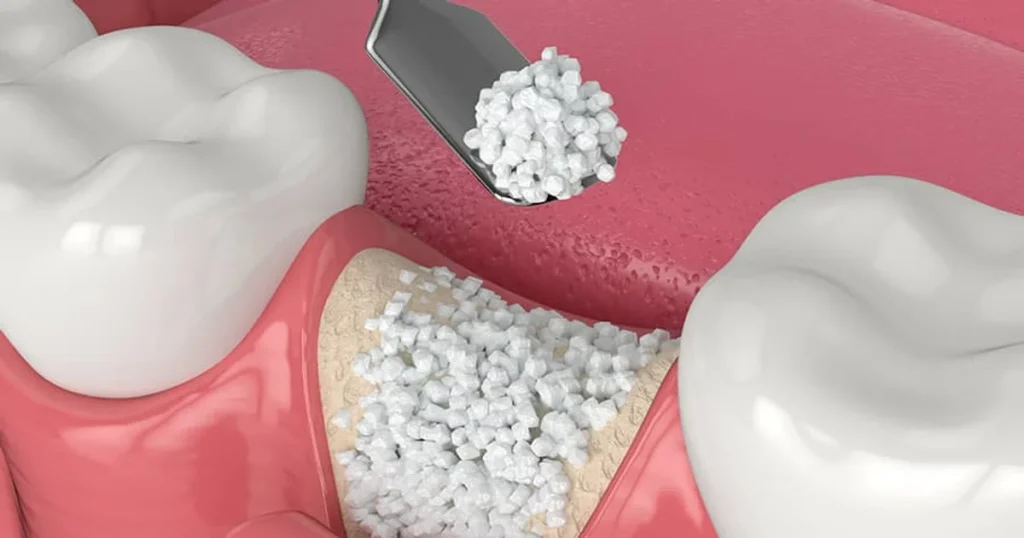 A picture demonstarting bone grafting procedure