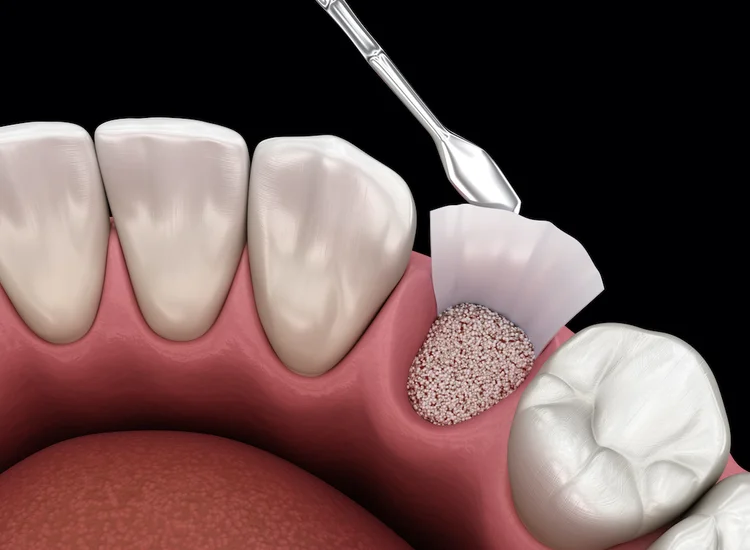 Bone grafting for dental implants