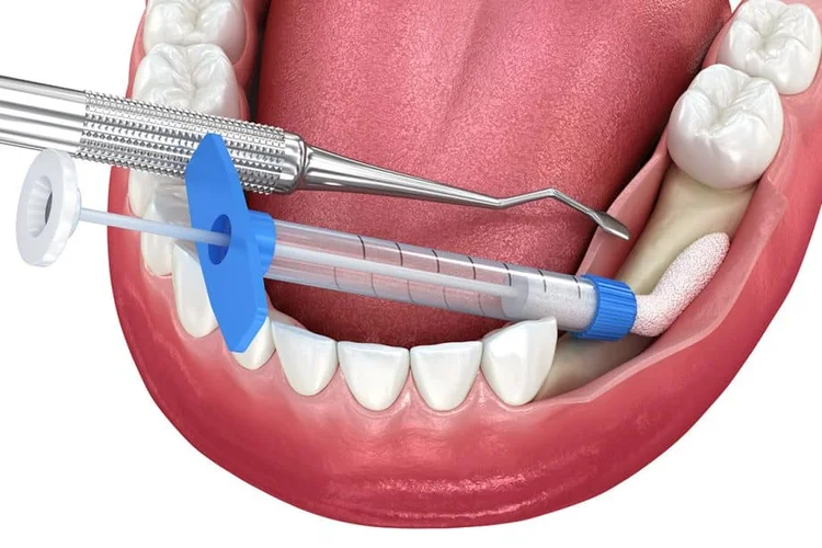 A picture of bone grafting