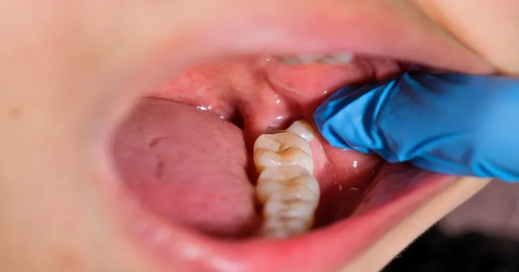 an image of a wisdom tooth