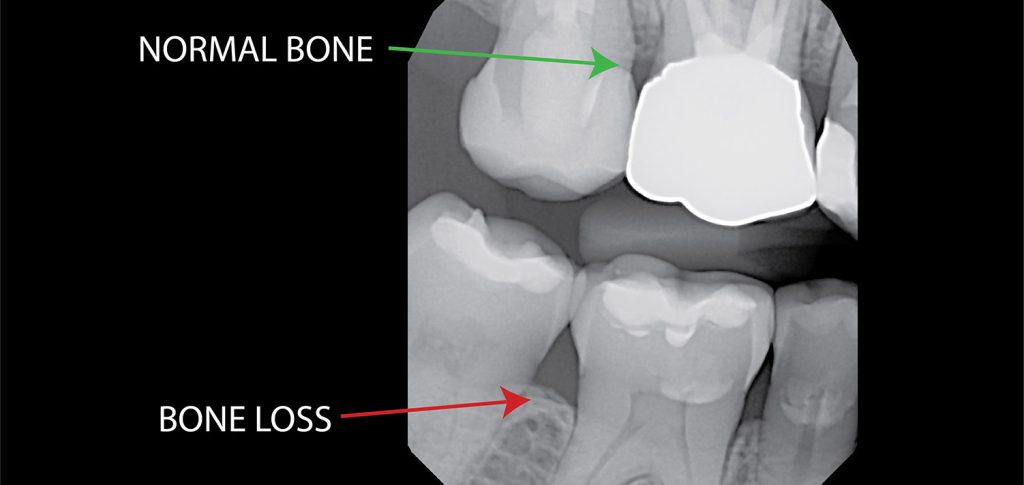 dental implants candidacy with bone loss