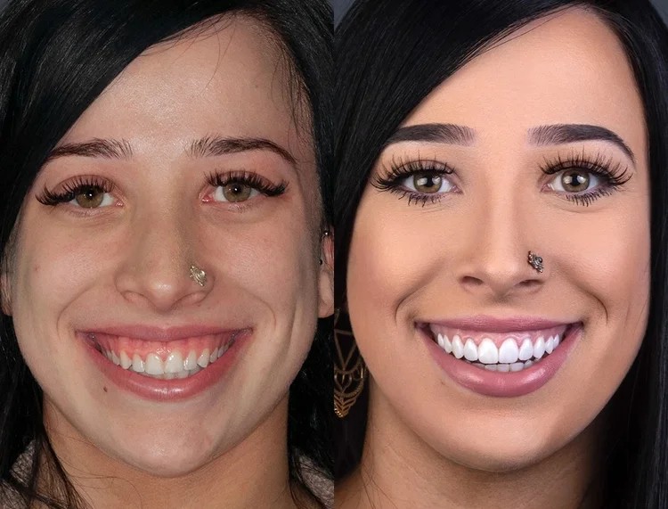 A before and after image of gum contouring