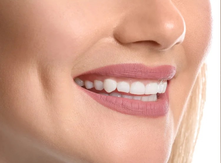 A picture of a woman after gum contouring