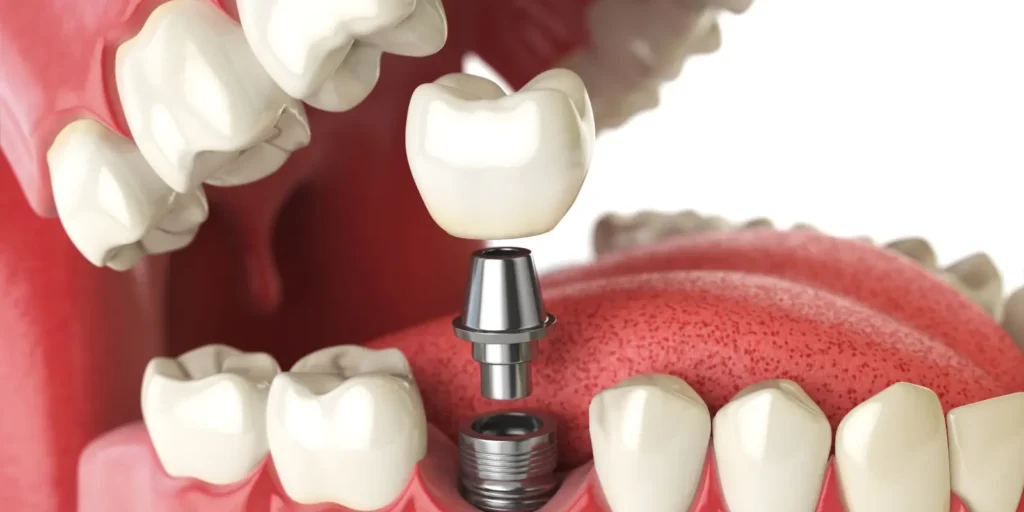 what a dental implant really is