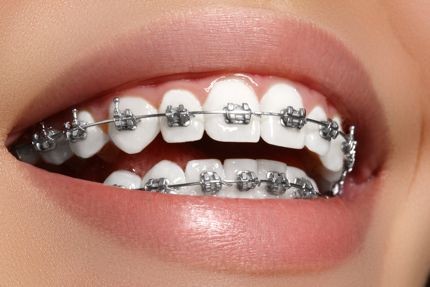 braces