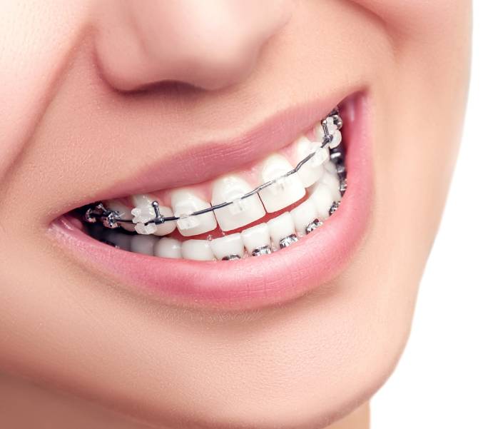 dental-braces