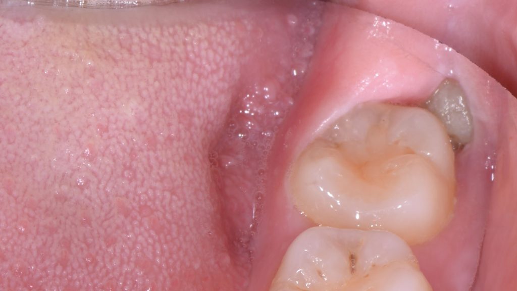wisdom tooth pain causes