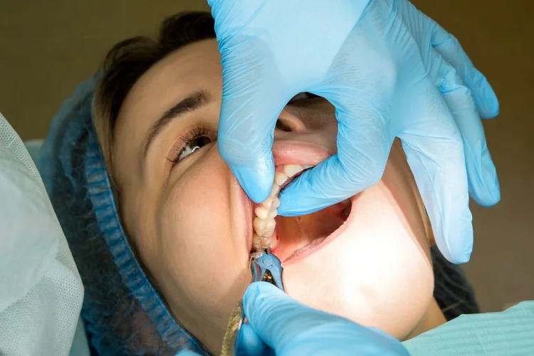a picture about wisdom teeth removal