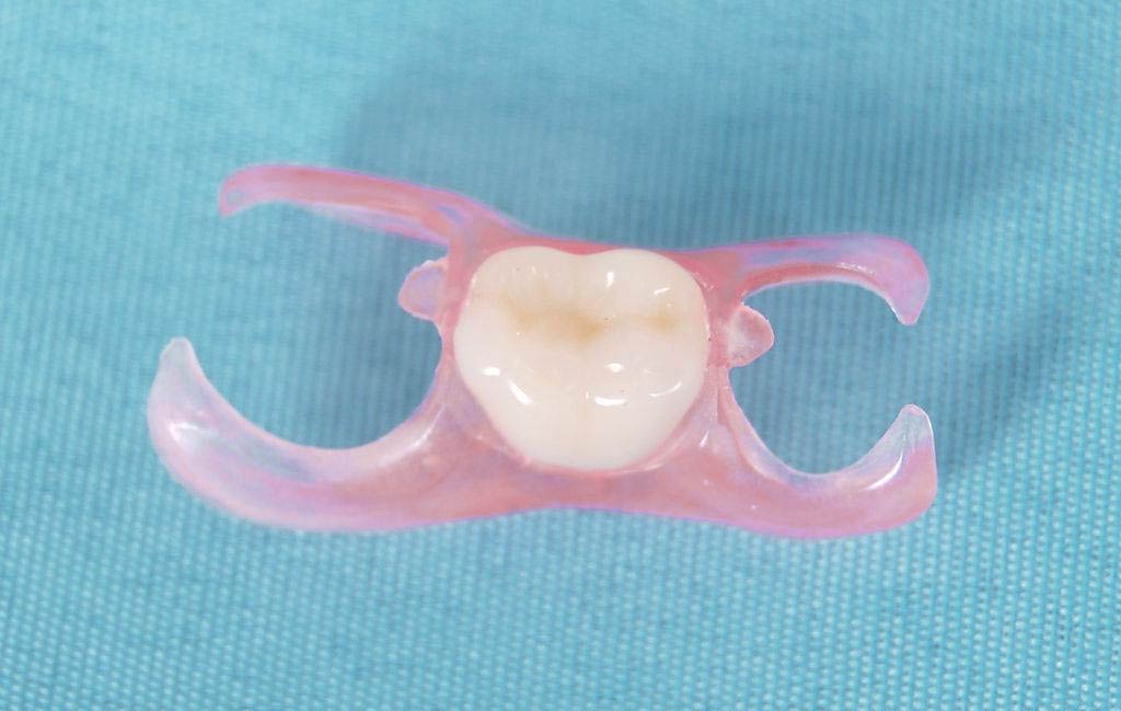 A Flipper Tooth for Temporary Replacement