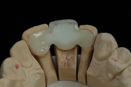 A Resin-Bonded or Maryland Bridge