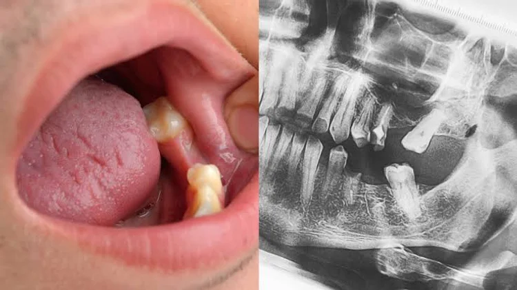 A picture of someone with missing teeth