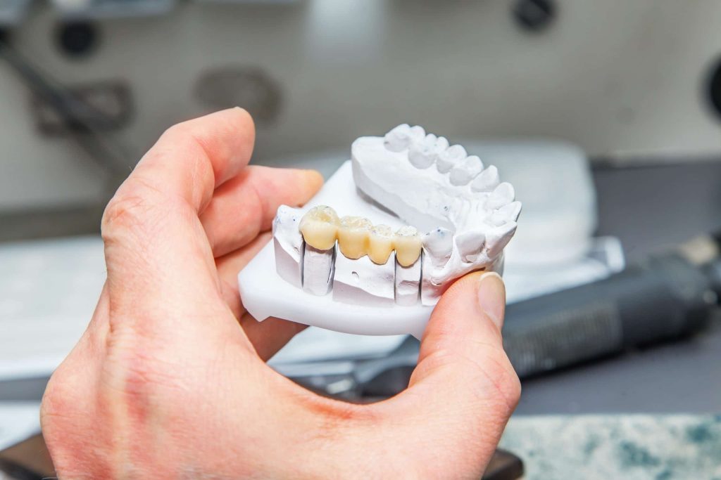 Alternatives to Dental Implants: Dental Bridge