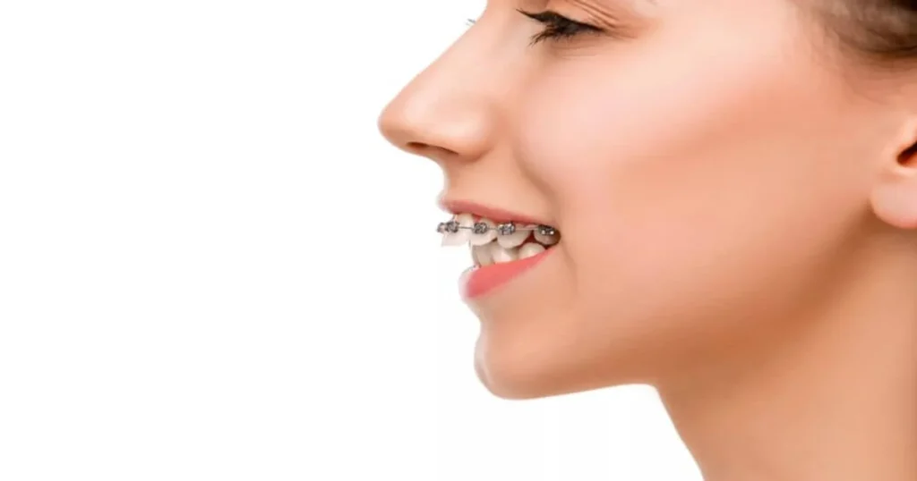 a picture of a woman with overjet
