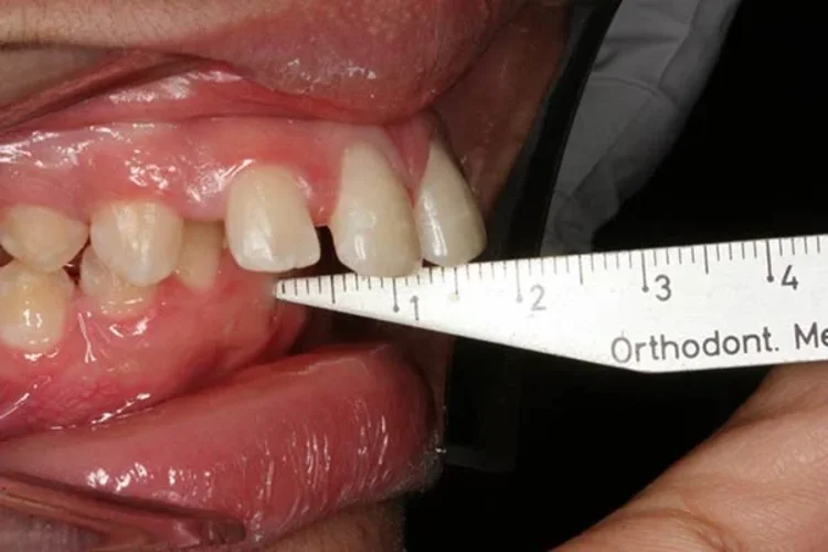 A picture showing the length of someone's buck teeth