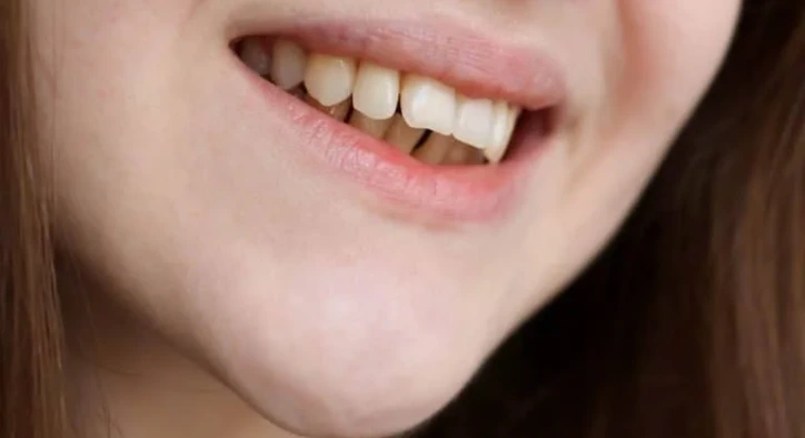 an image of a girl with overjet