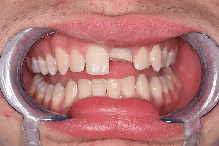 A close-up picture of someone's cracked tooth