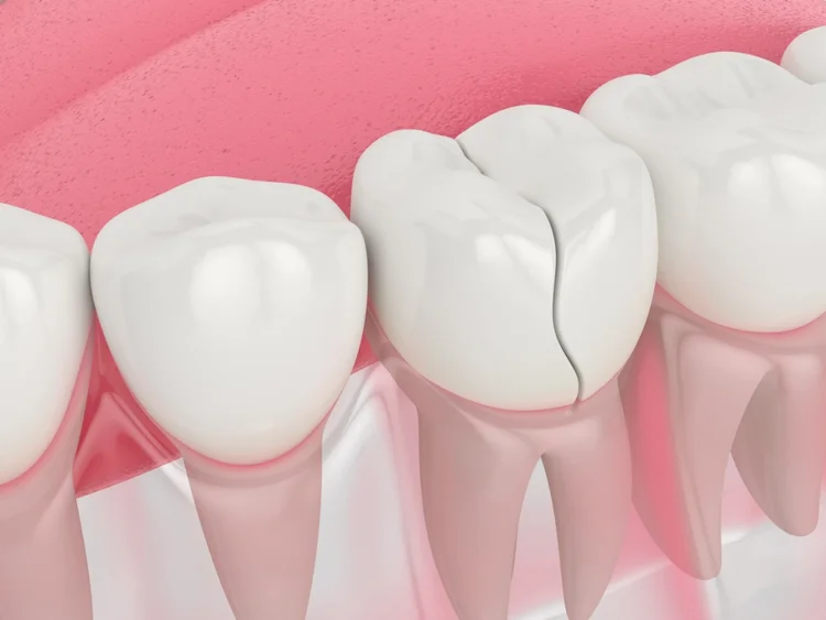 A picture representing vertical tooth fracture