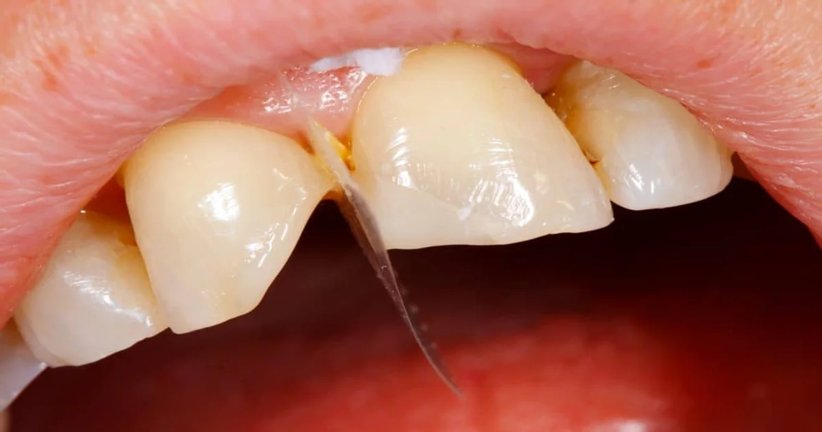 A picture of a cracked tooth