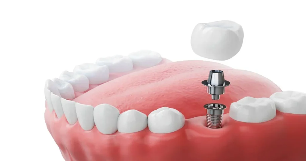 A picture representing screwless implants