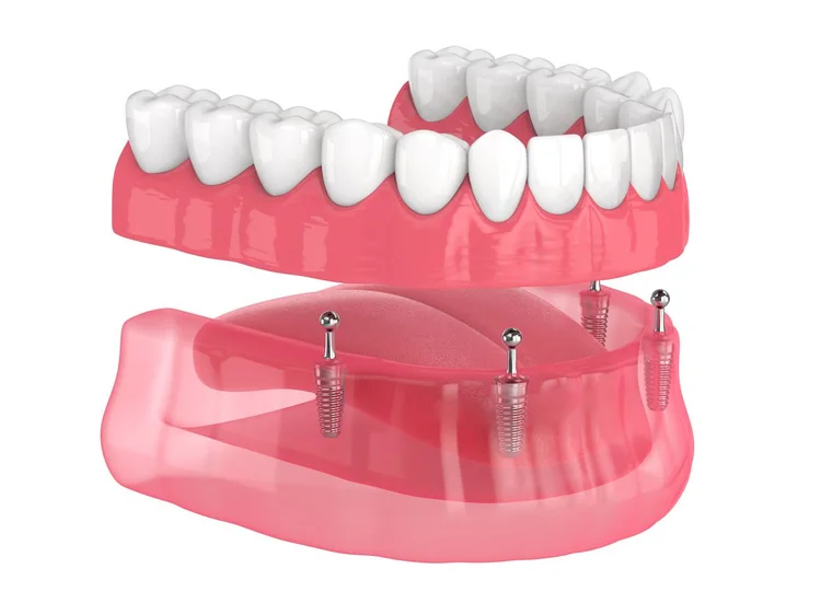 A picture of screwless implants
